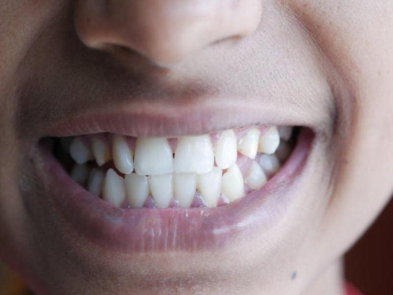 הלבנת שיניים